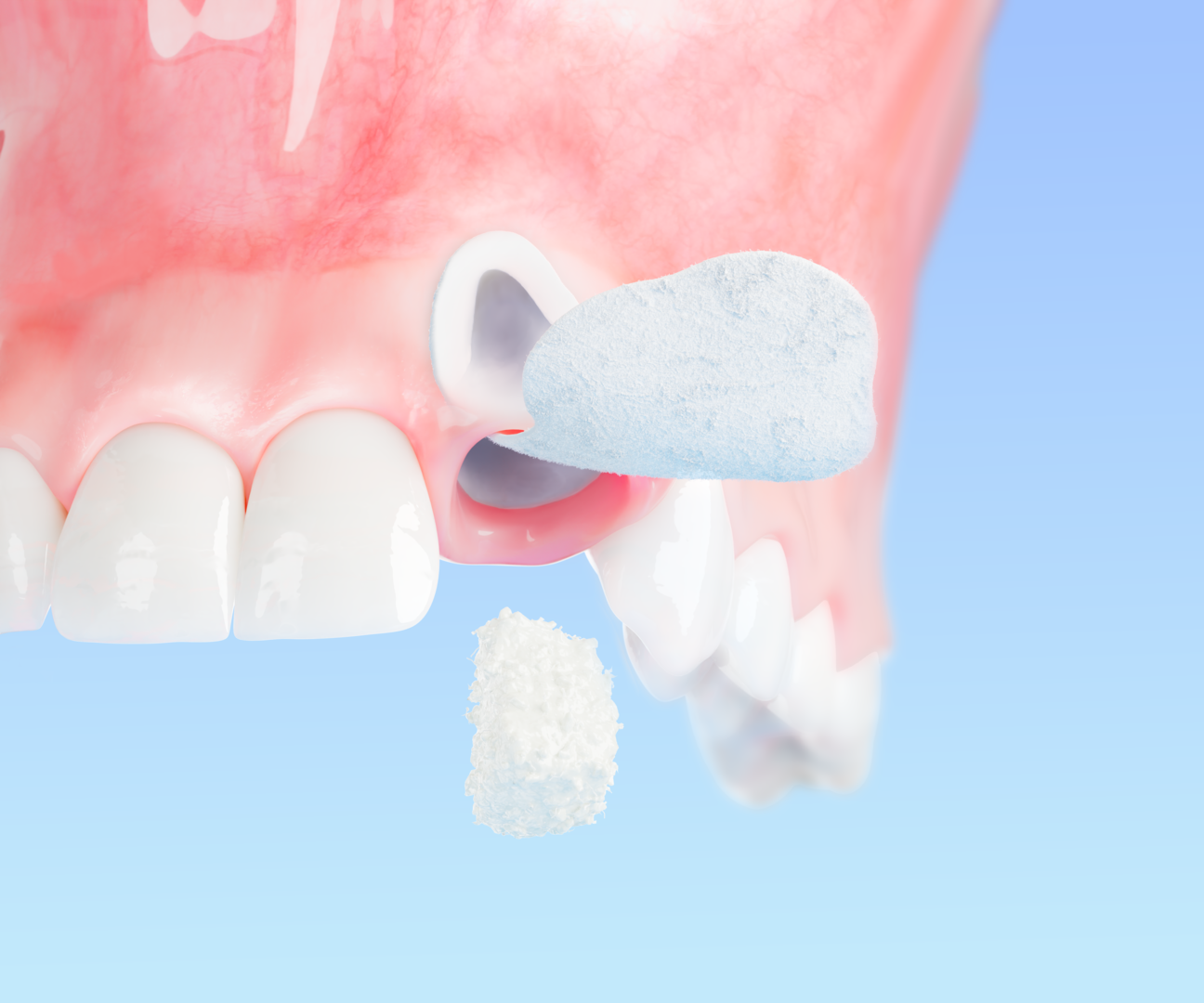 Geistlich Bio-Gide® Shape