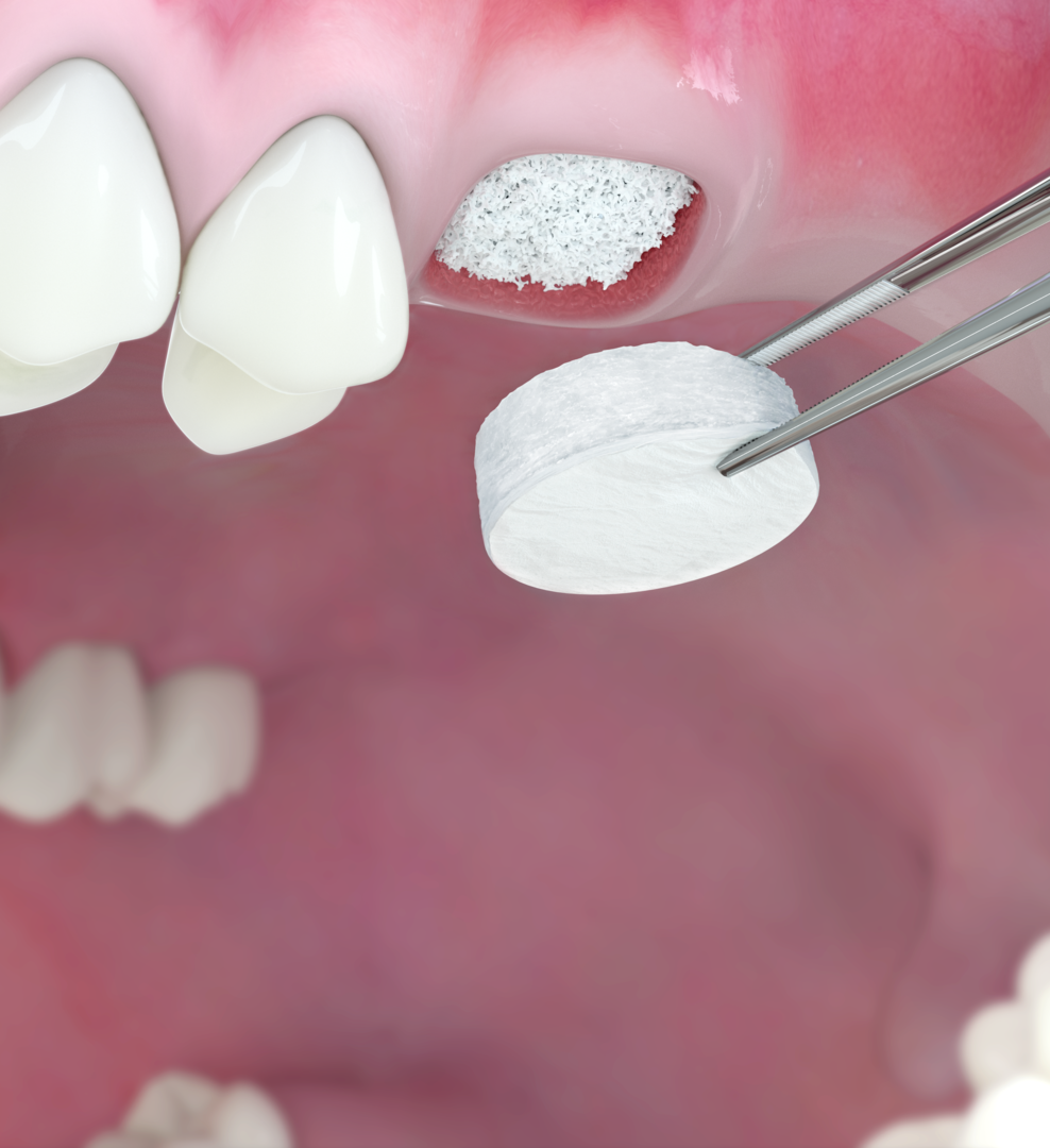 Geistlich Mucograft® Seal